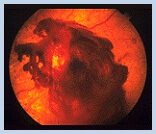 Boulder Eye Care &amp; Surgery Center Doctors diabetic eye 01 - Diabetic Eye Disease
