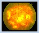Boulder Eye Care &amp; Surgery Center Doctors diabetic eye 03 - Diabetic Eye Disease