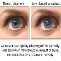 With and without cataract