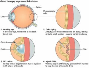 Boulder Eye Care &amp; Surgery Center Doctors Gene Therapy for Retina 300x228 - The Future of Ophthalmology is Now - Gene Therapy