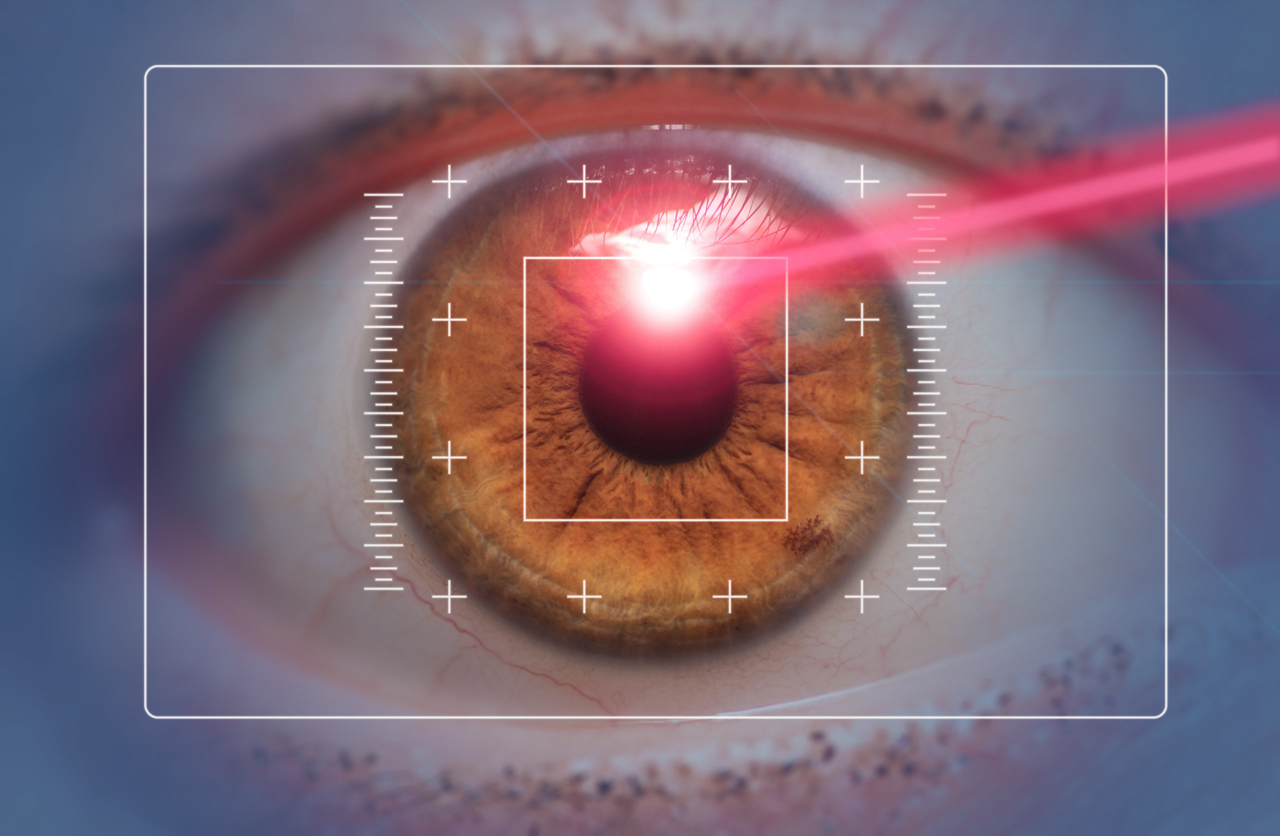 LASIK Eye Surgery Explained