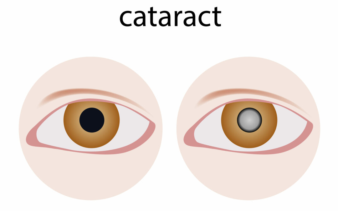 eye care site explains what cataracts are