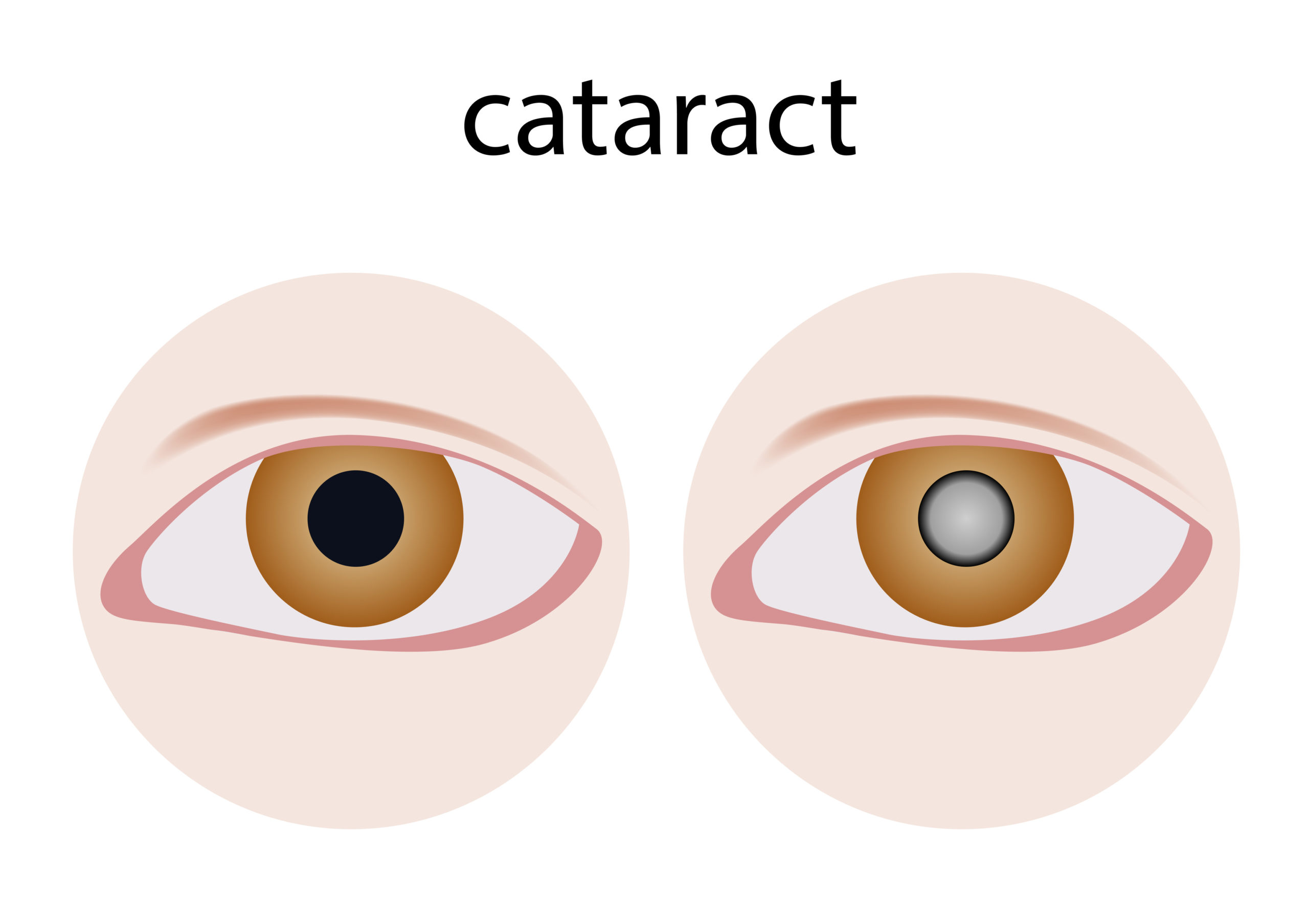 What’s a Cataract and How Is It Treated?