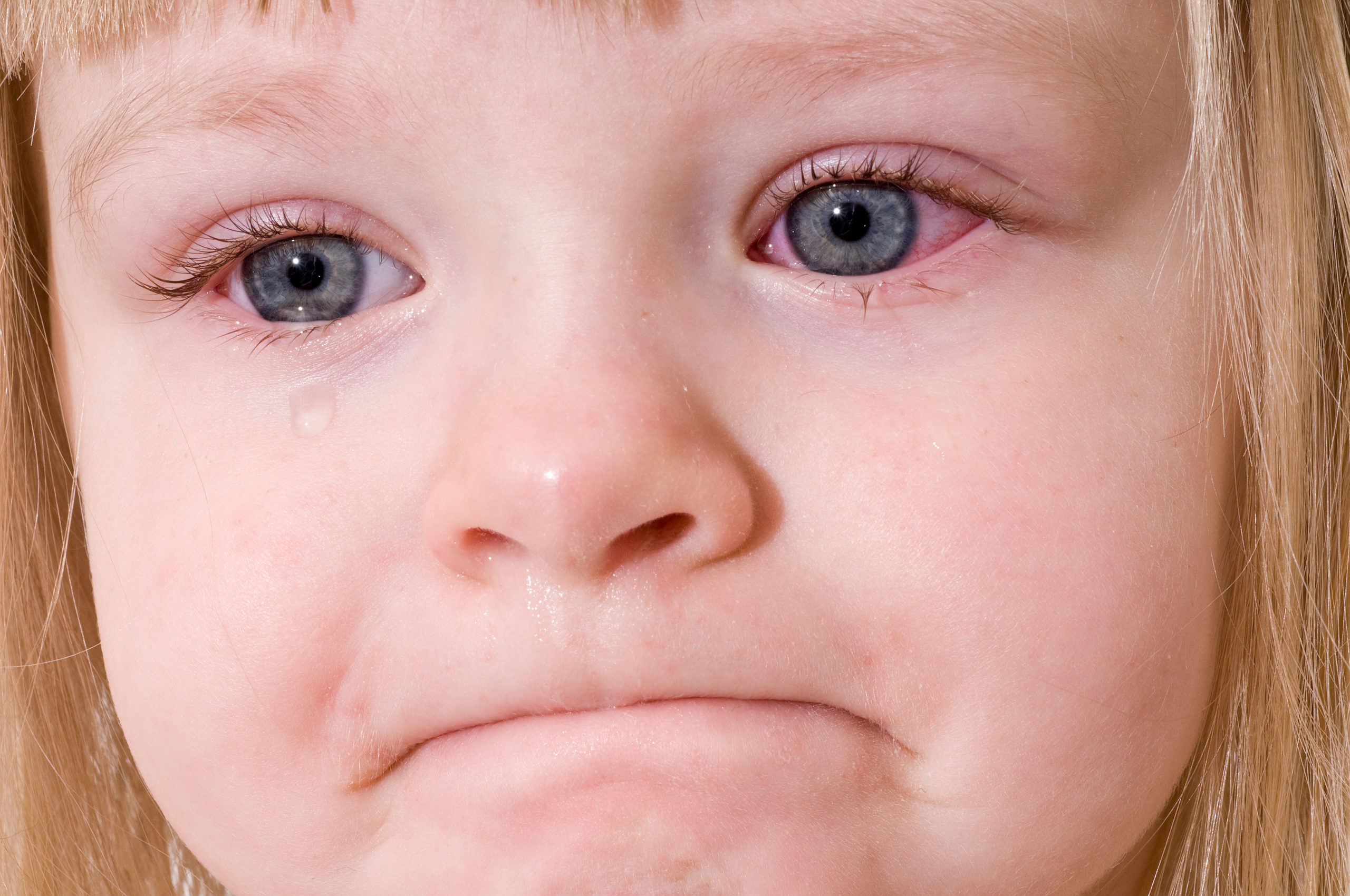 Pink Eye: The Basics on Allergic, Bacterial, Viral, and Giant Papillary Conjunctivitis