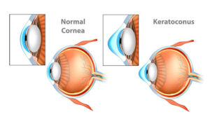 Boulder Eye Care &amp; Surgery Center Doctors Keratoconus 2 300x180 - What to know about Keratoconus