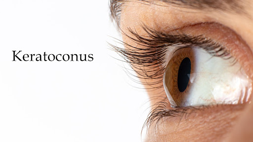 What to know about Keratoconus